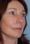 Neck Lift case #4986