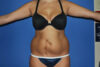 Liposuction case #4550