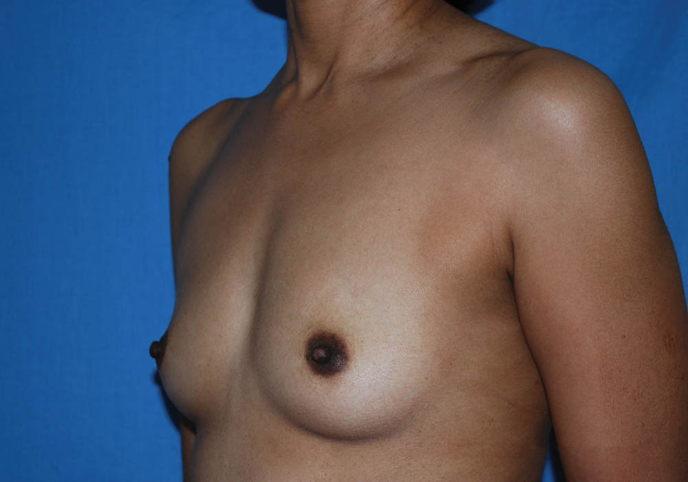 Breast Augmentation case #3944