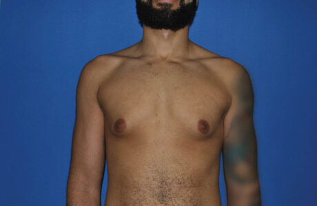 Male Breast Reduction case #4892