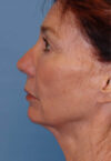 Neck Lift case #4986