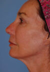 Neck Lift case #4986