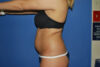 Liposuction case #4550