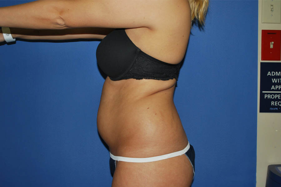 Liposuction case #4550