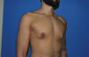 Male Breast Reduction case #4892