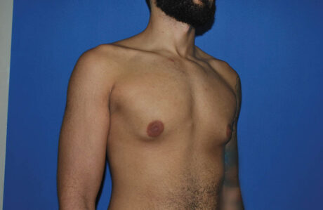 Male Breast Reduction case #4892