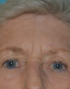 Forehead Lift case #4411