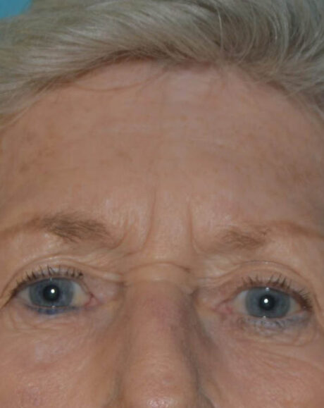 Forehead Lift case #4411