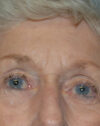 Forehead Lift case #4411