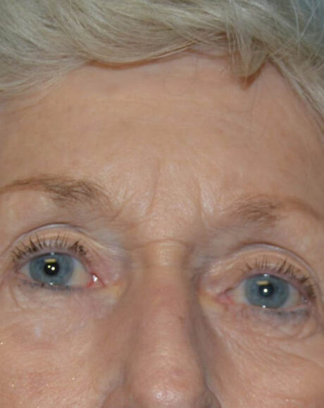 Forehead Lift case #4411
