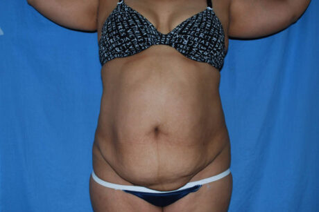 Mommy Makeover case #5600