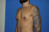 Male Breast Reduction case #4892