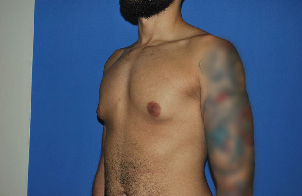 Male Breast Reduction case #4892
