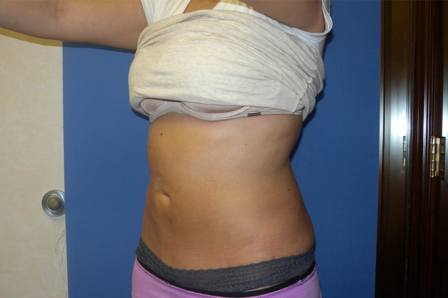 Liposuction case #4550