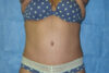 Mommy Makeover case #5600