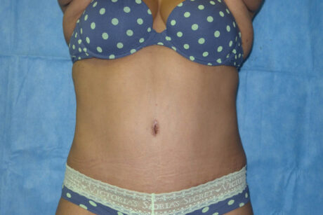 Mommy Makeover case #5600