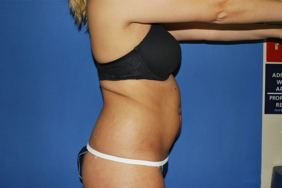 Liposuction case #4550