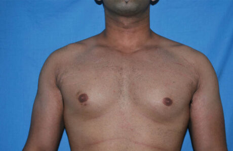 Male Breast Reduction case #4899