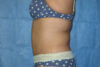 Mommy Makeover case #5600