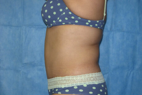 Mommy Makeover case #5600