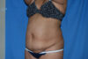 Mommy Makeover case #5600