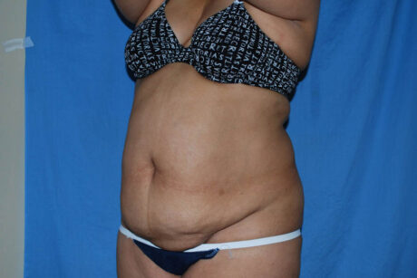 Mommy Makeover case #5600