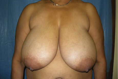 Breast Reduction case #4077