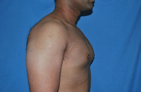 Male Breast Reduction case #4899