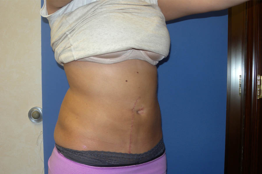 Liposuction case #4550