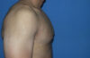Male Breast Reduction case #4899
