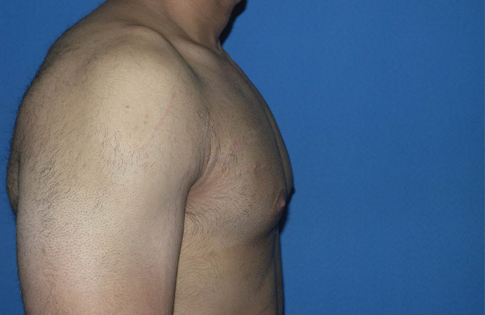 Male Breast Reduction case #4899