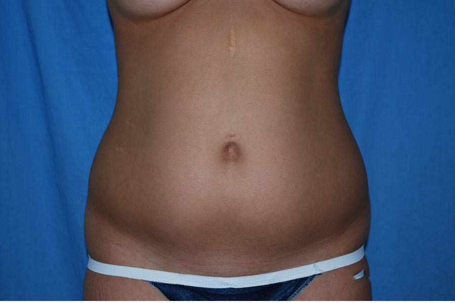 Liposuction case #4561