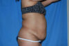Mommy Makeover case #5600
