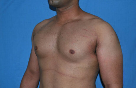 Male Breast Reduction case #4899