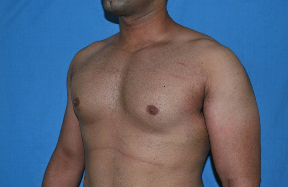 Male Breast Reduction case #4899