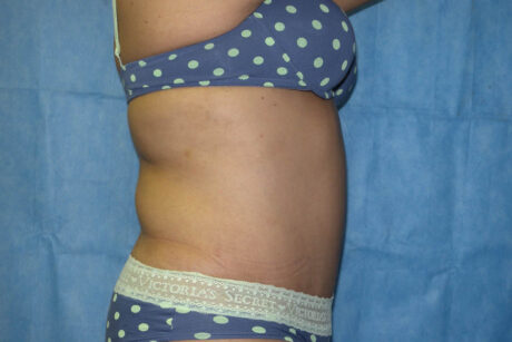 Mommy Makeover case #5600