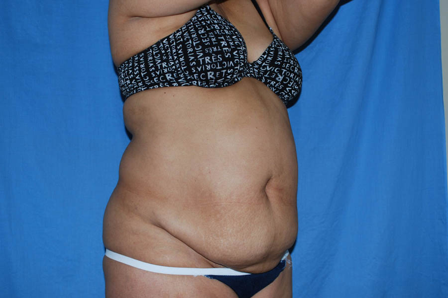 Mommy Makeover case #5600