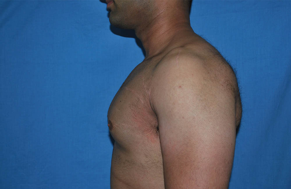 Male Breast Reduction case #4899
