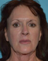Forehead Lift case #4424
