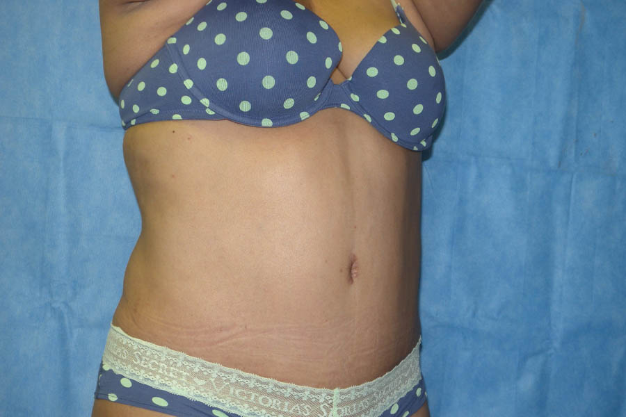 Mommy Makeover case #5600