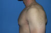 Male Breast Reduction case #4899