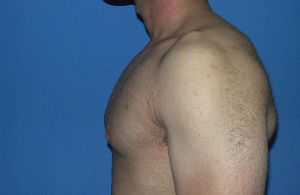 Male Breast Reduction case #4899
