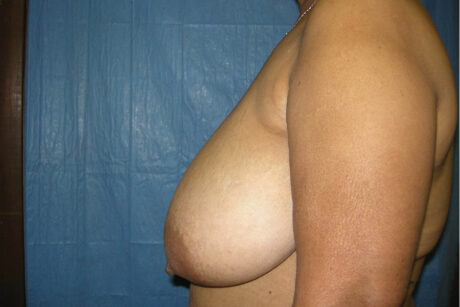 Breast Reduction case #4077