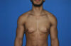 Male Breast Reduction case #4908