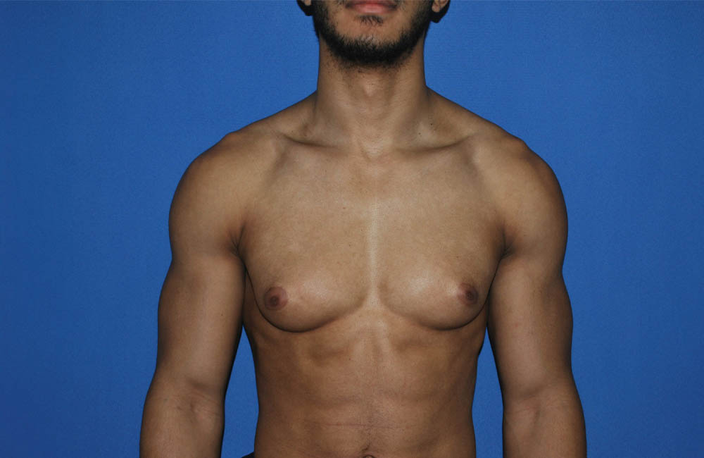 Male Breast Reduction case #4908