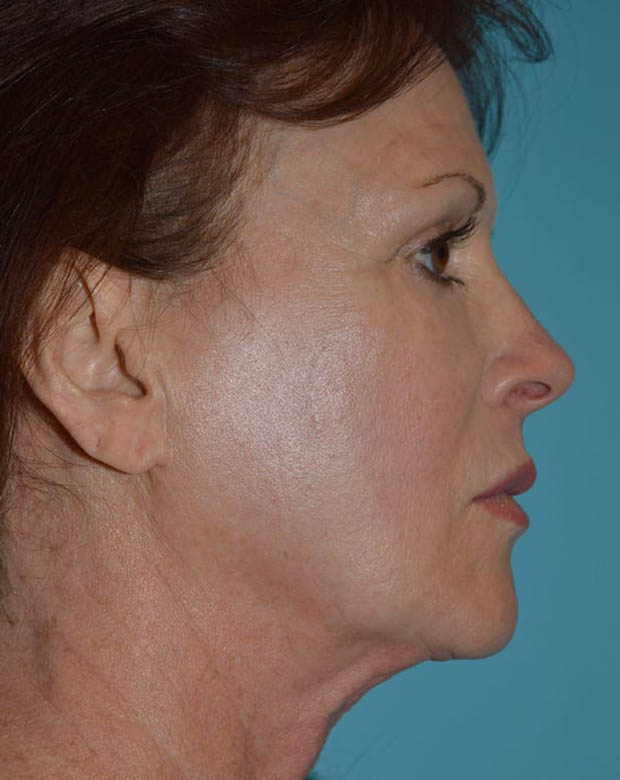Forehead Lift case #4424