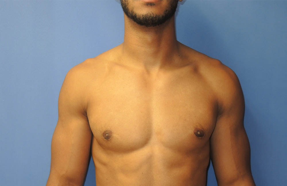 Male Breast Reduction case #4908