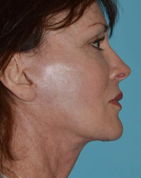 Forehead Lift case #4424