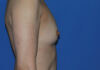 Breast Augmentation case #3963