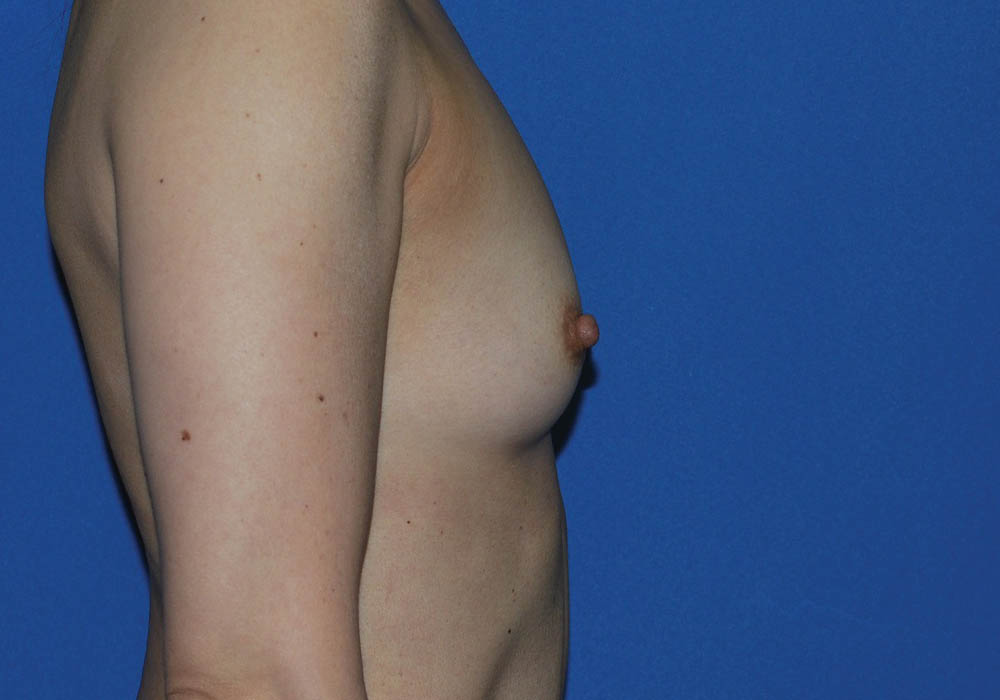 Breast Augmentation case #3963
